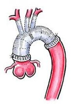 stent_img09.jpg