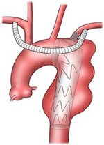 stent_img10.jpg