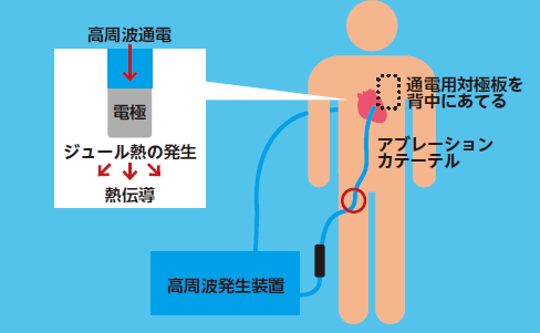 ABL原理.png