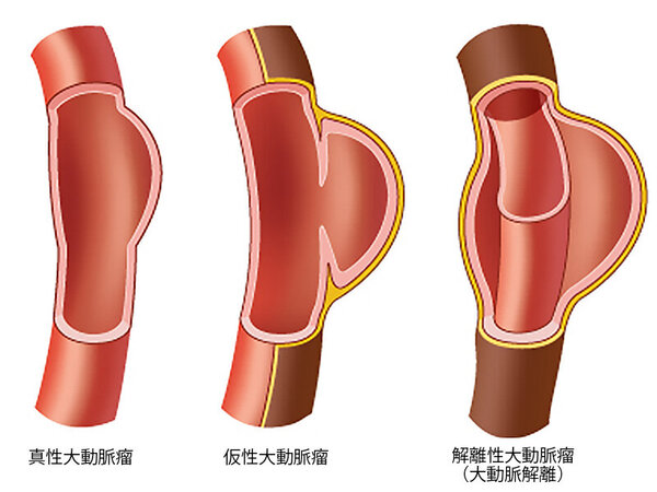 stent_img01.jpg